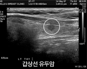 갑상선 유두암