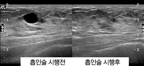 흡인술 시행전/후