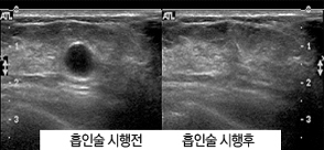 흡인술 시행전/후